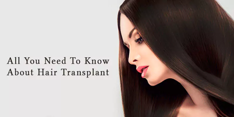 5 Important Things to Know About Hair Transplant