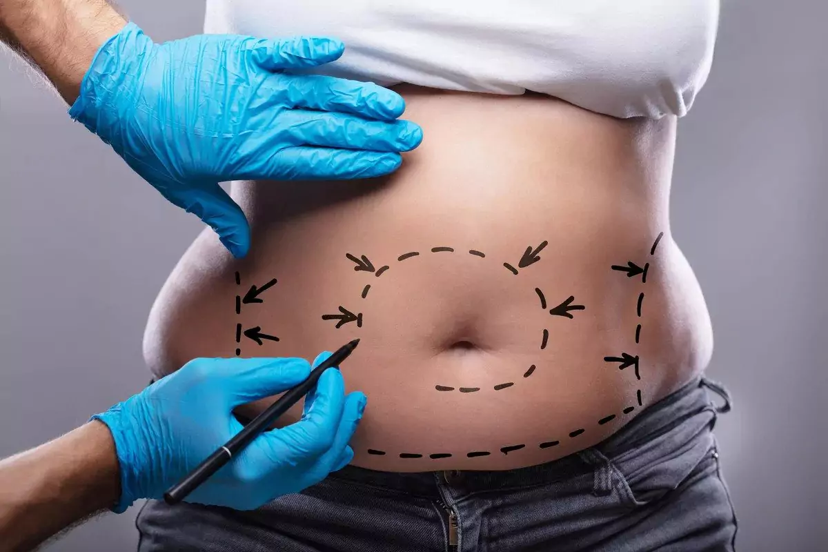 All you need to know about Liposuction