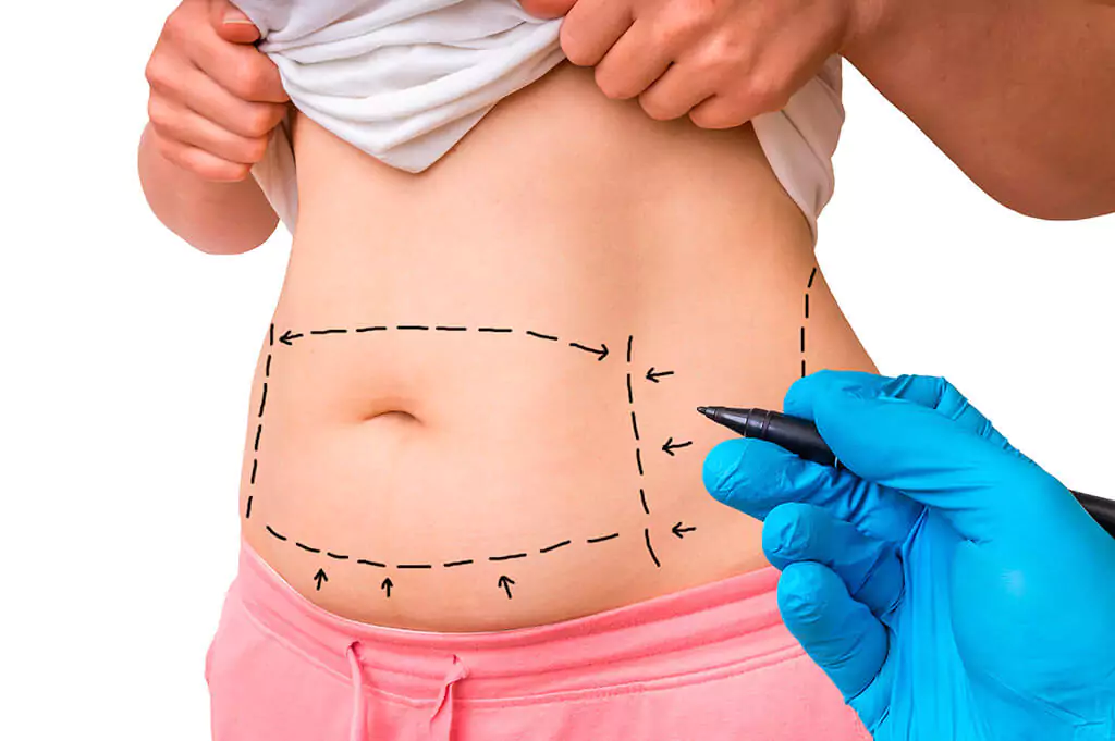 Tummy Tuck Surgery or Abdominoplasty: Benefits, Risks, Complications and more