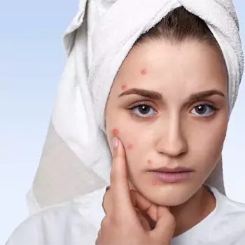 Acne is the most common problem in adolescents and young adults