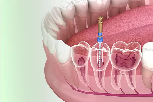 Saving Your Smile: The Benefits of Root Canal Treatment