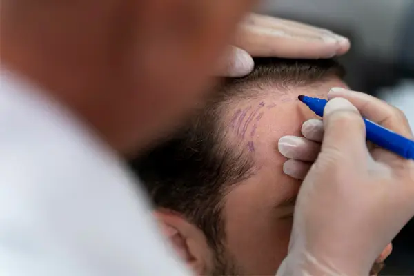 Fighting hair loss?  Here's Why a Hair Transplant Should Be Your Top Choice
